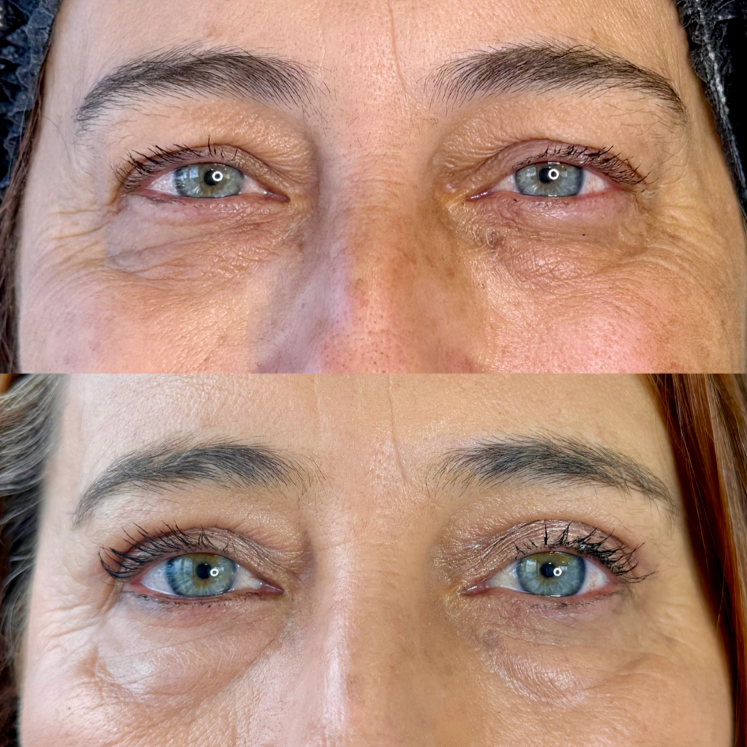 Blefaroplastia