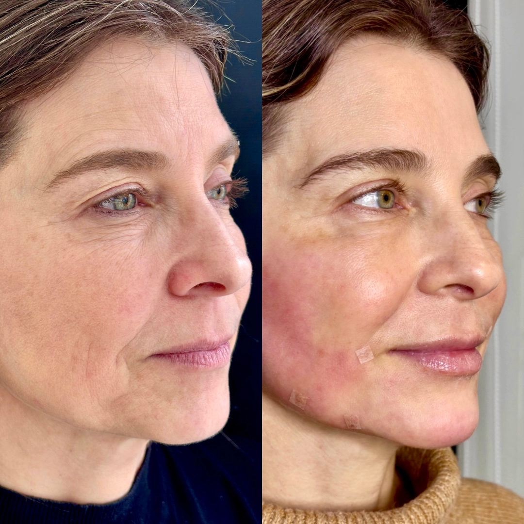 Harmonização Facial