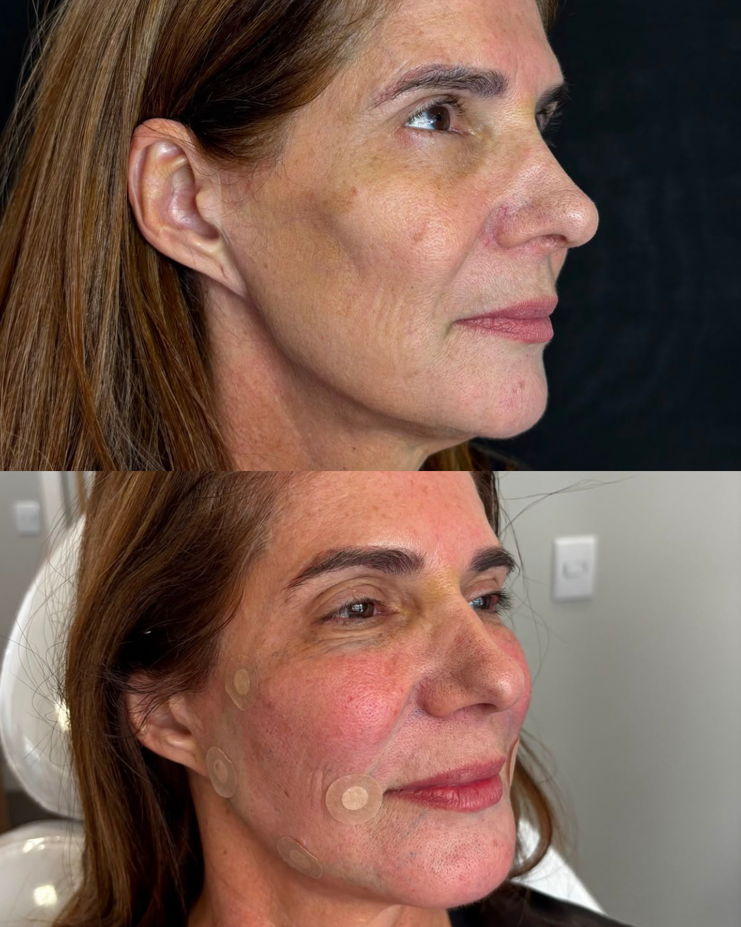 Lipoenxertia Facial